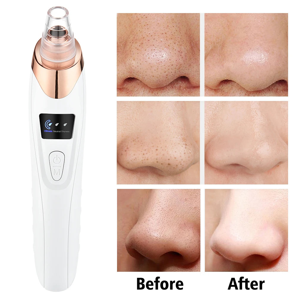 3 Suction Mode Blackhead Remover